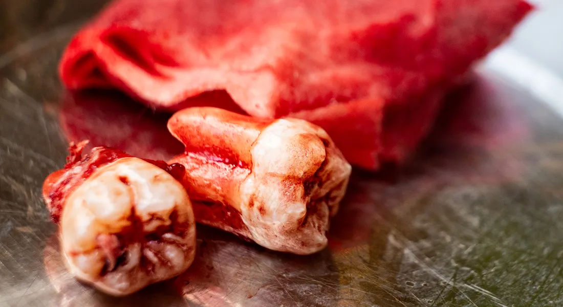 Tooth Extractions & Wisdom Teeth Removal Toronto