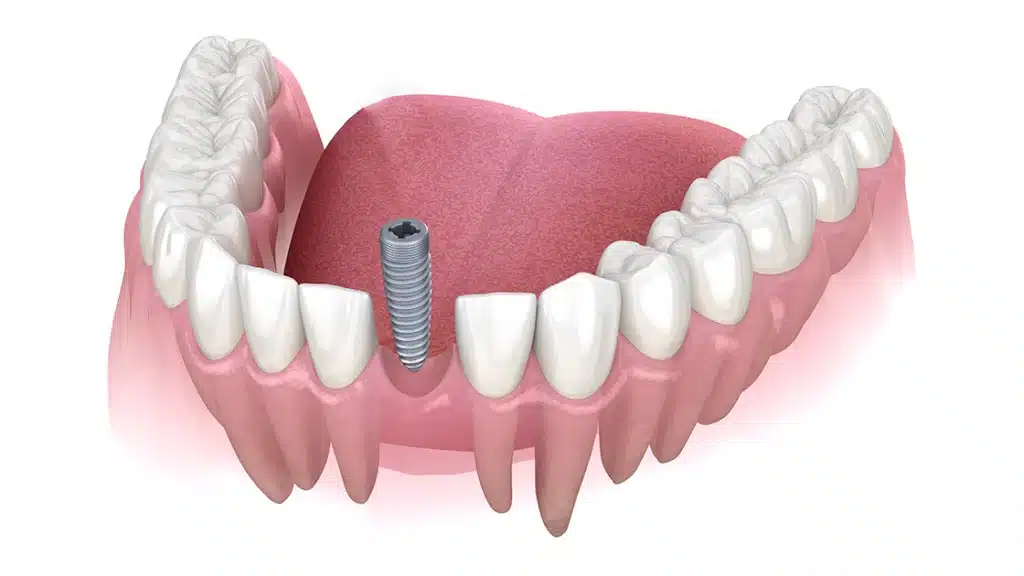 Dental Implant Cost in Toronto 2026: Full Price Breakdown