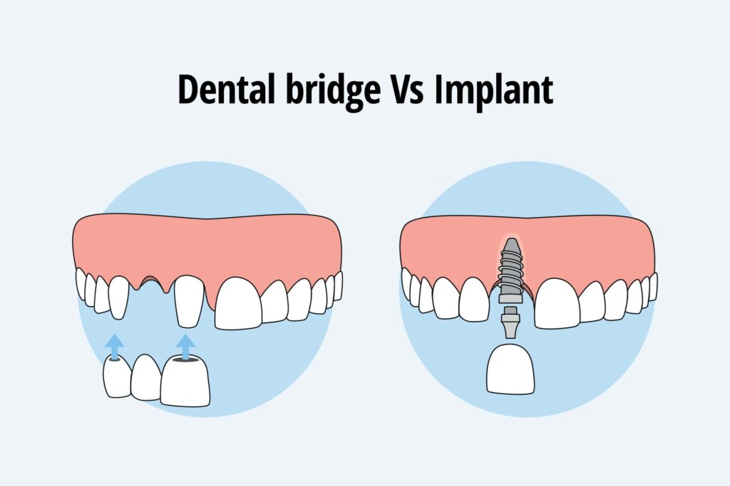 Dental Implant vs Bridge