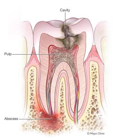 Abscessed Tooth: Symptoms and Emergency Care Guide