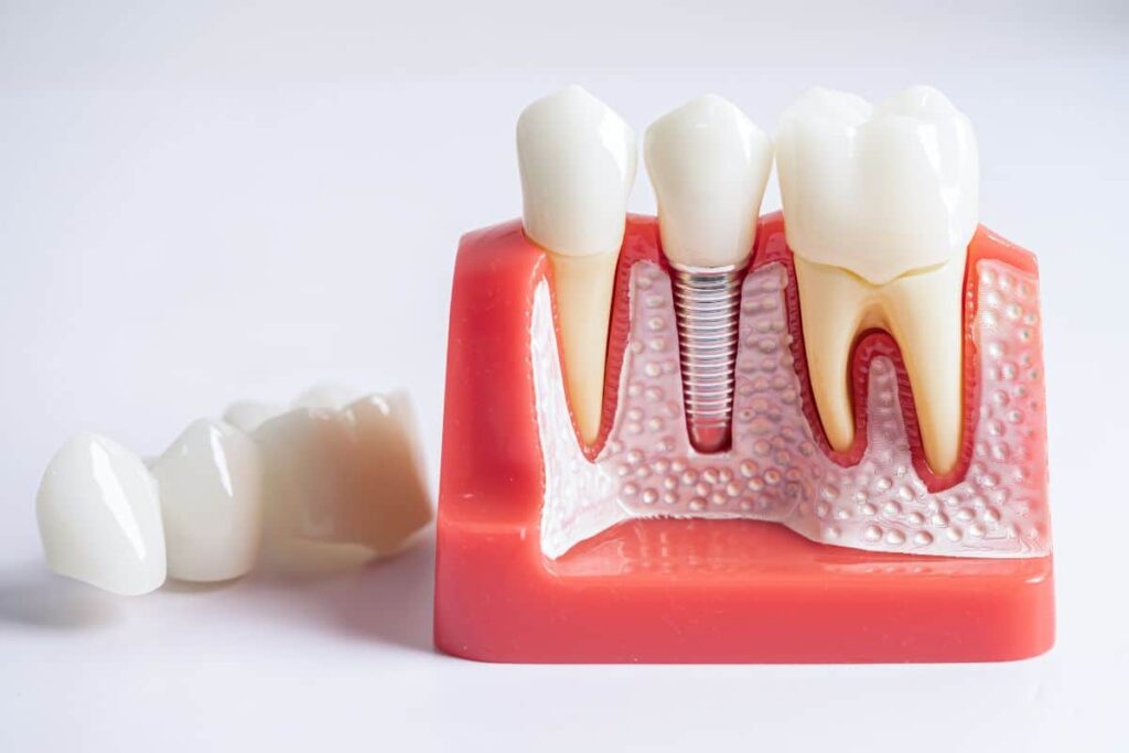 How Much Does a Root Canal Cost in Toronto?