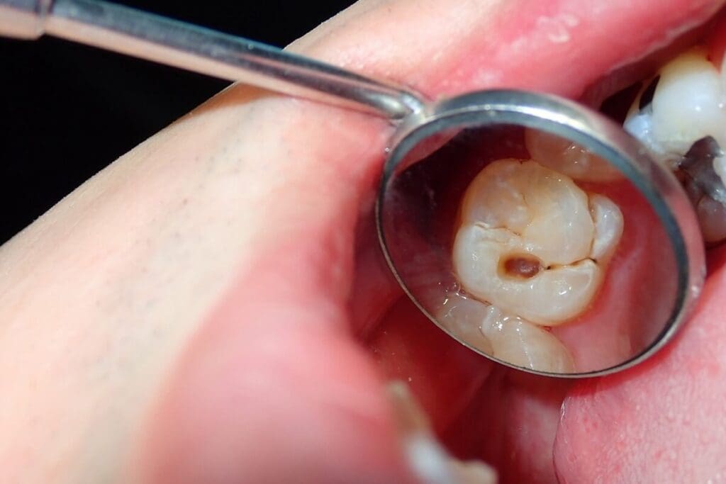 Cracked Tooth: Symptoms and Treatment Options