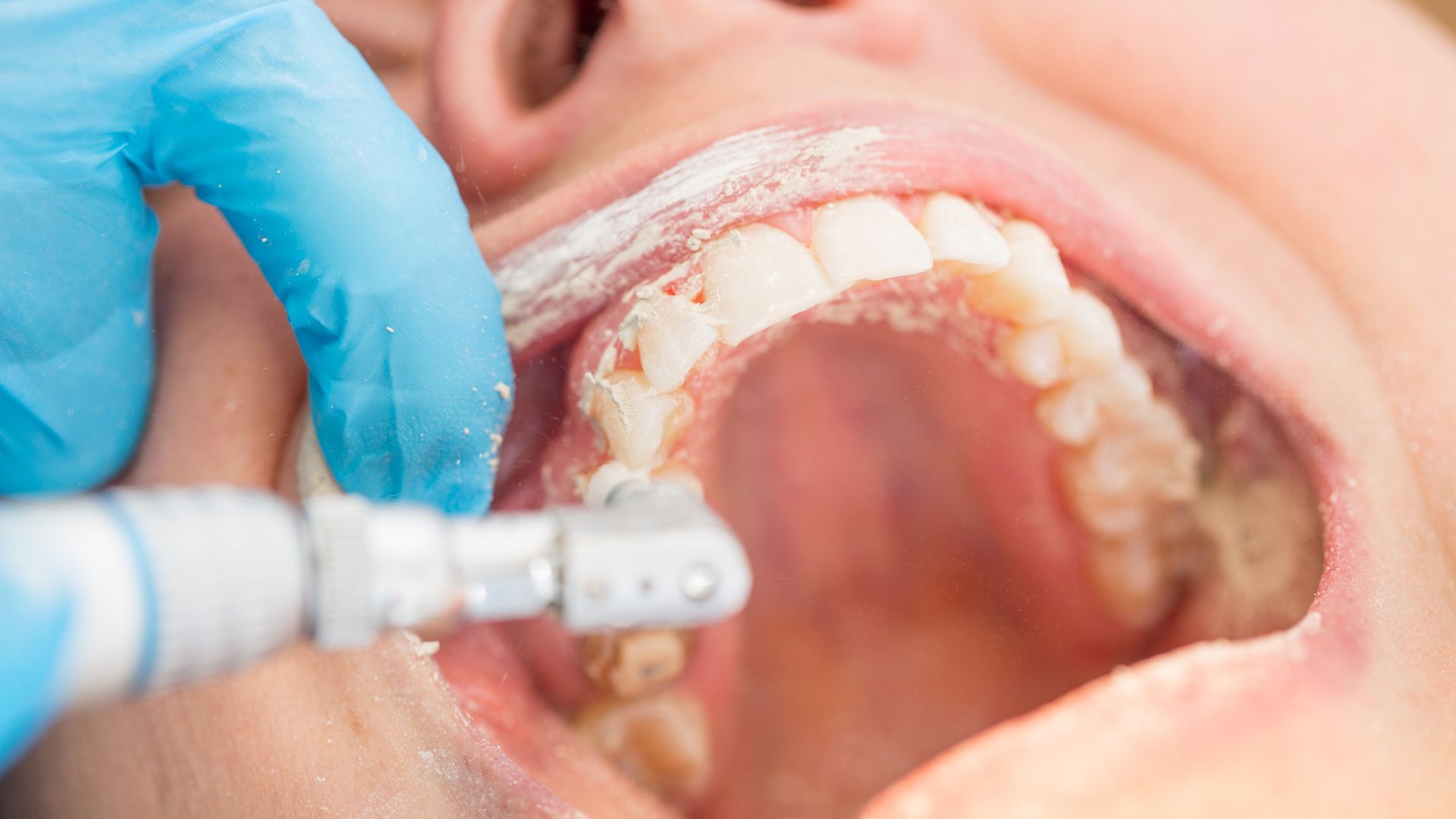How Often Should You Get a Professional Teeth Cleaning?