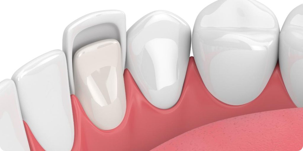 How Much Do Porcelain Veneers Cost in Toronto? (2026 Pricing Guide)