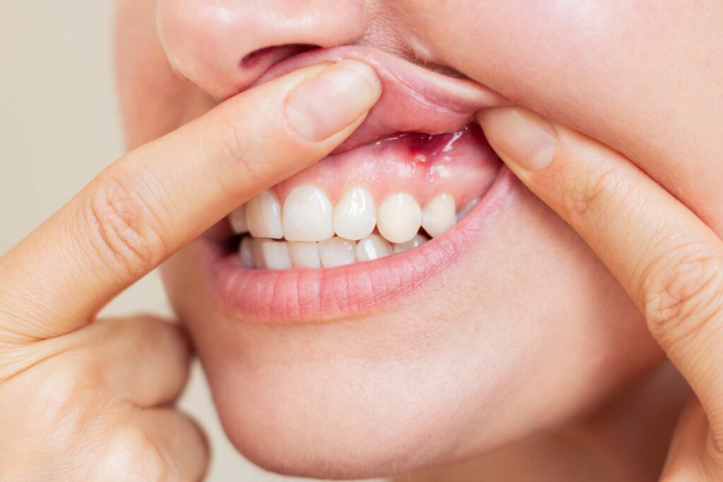 7 Signs of Gum Disease You Shouldn't Ignore
