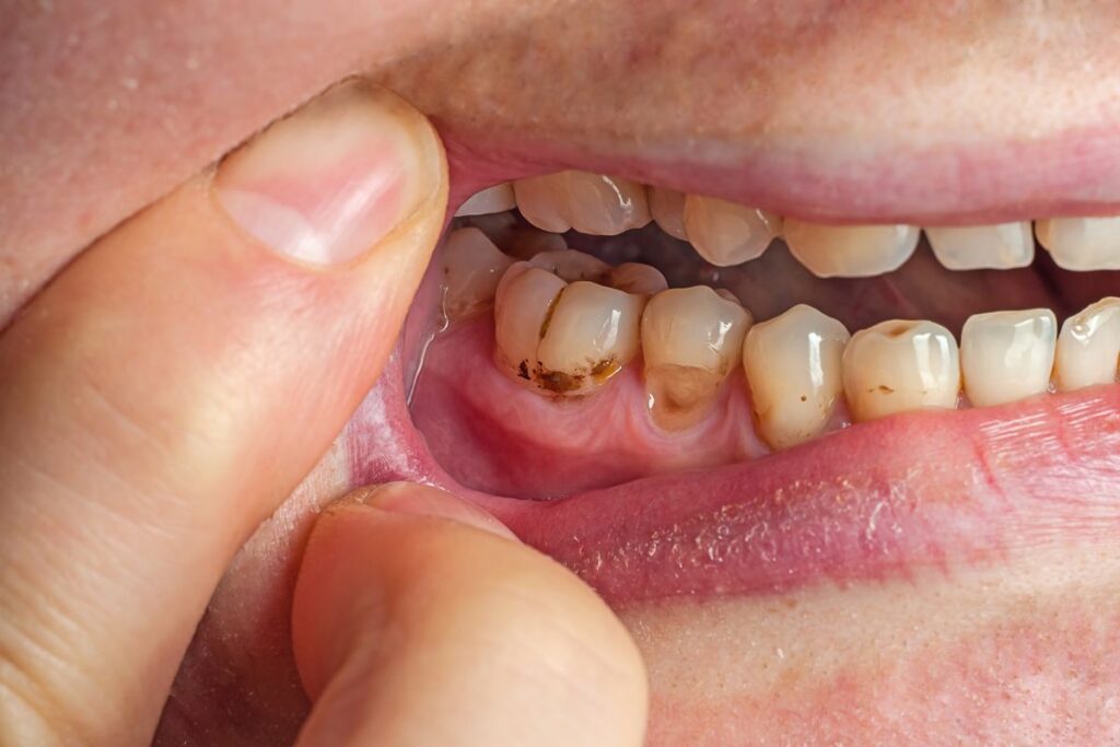 7 Signs You Have a Cavity (And What to Do Next)