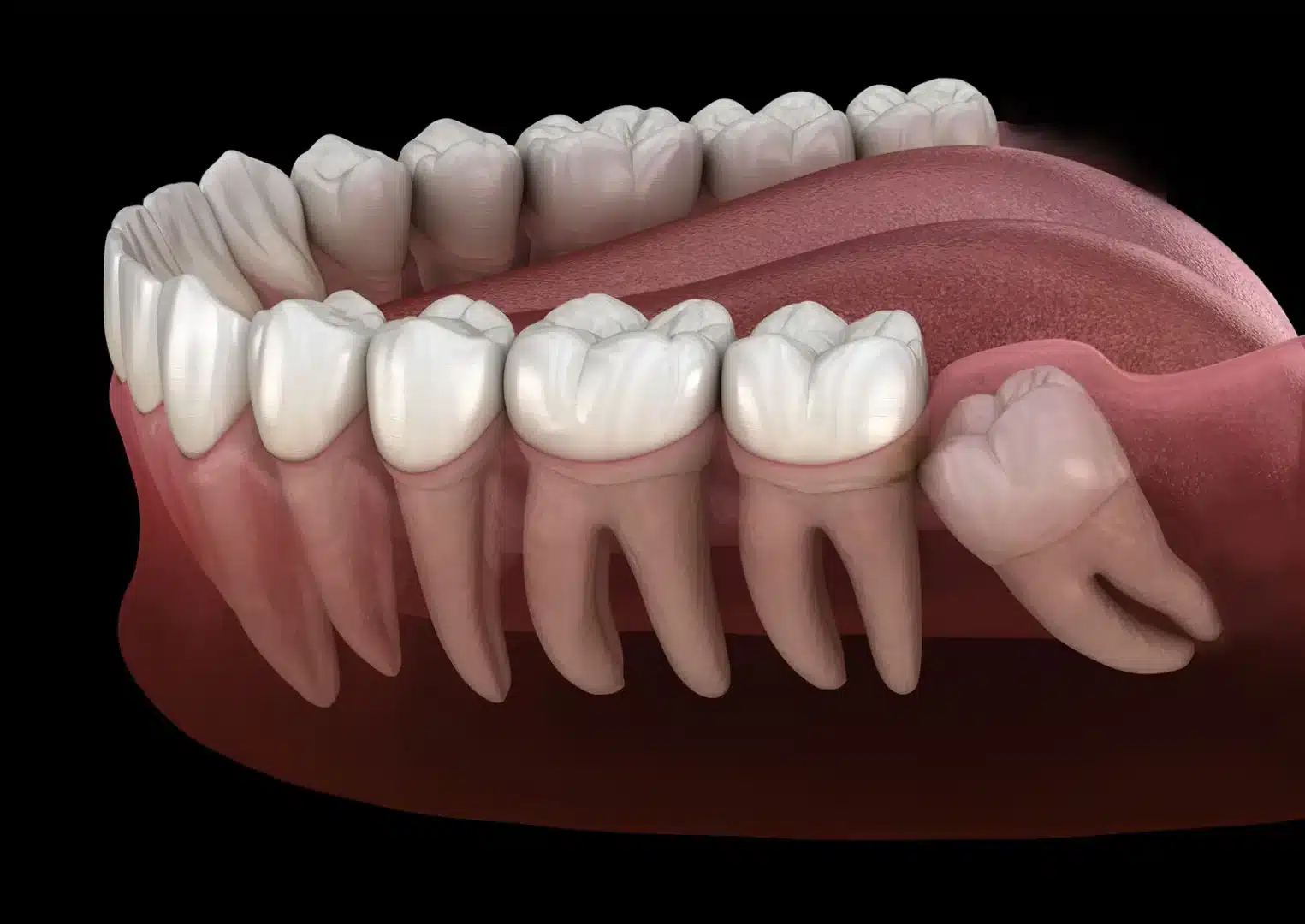 Wisdom Tooth Extraction: Recovery Timeline & Tips