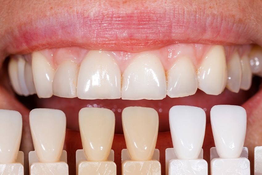 Porcelain Veneers in Downtown