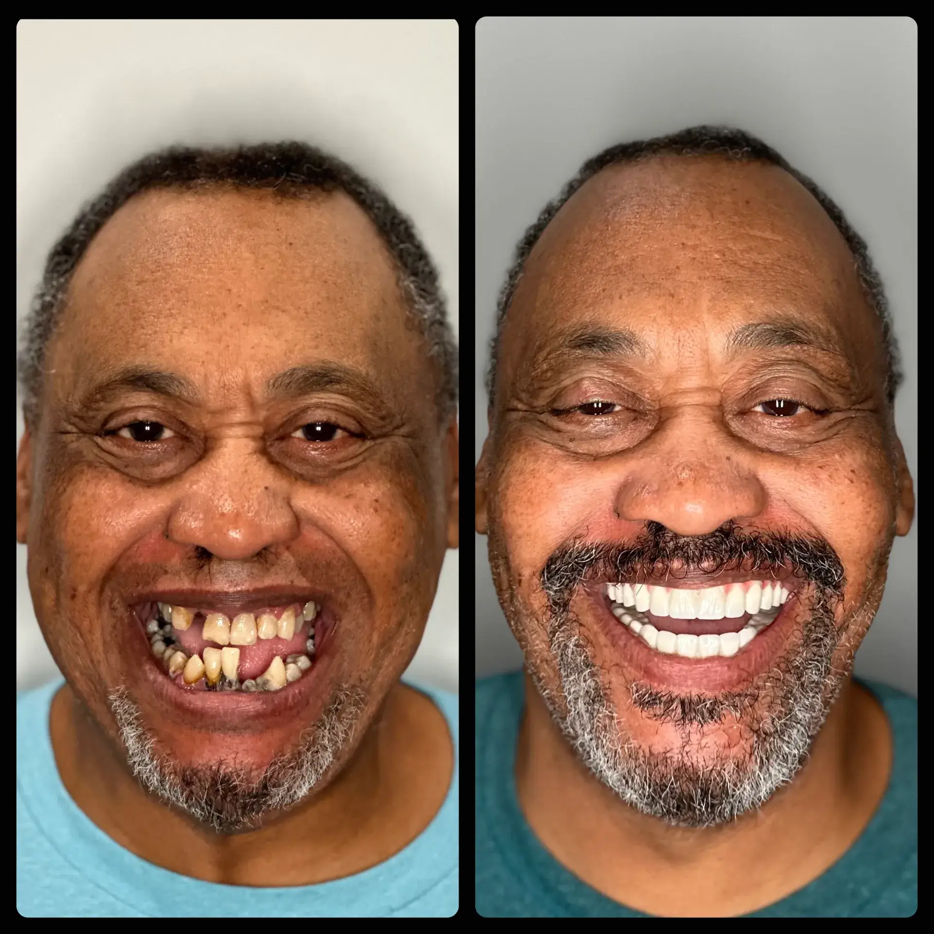 Porcelain Veneers