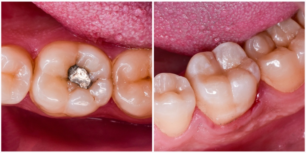 Composite vs Amalgam Fillings