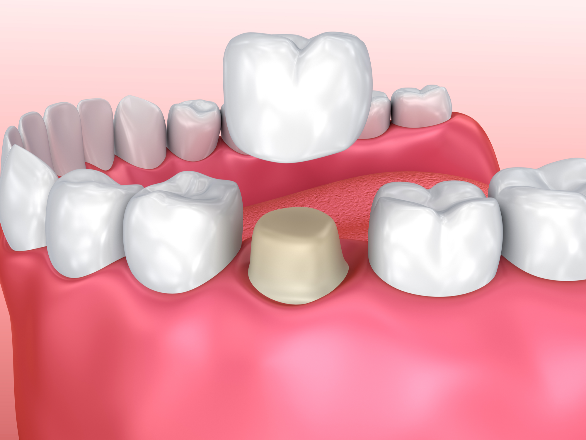 Dental Crown vs Filling: When Do You Need Each?