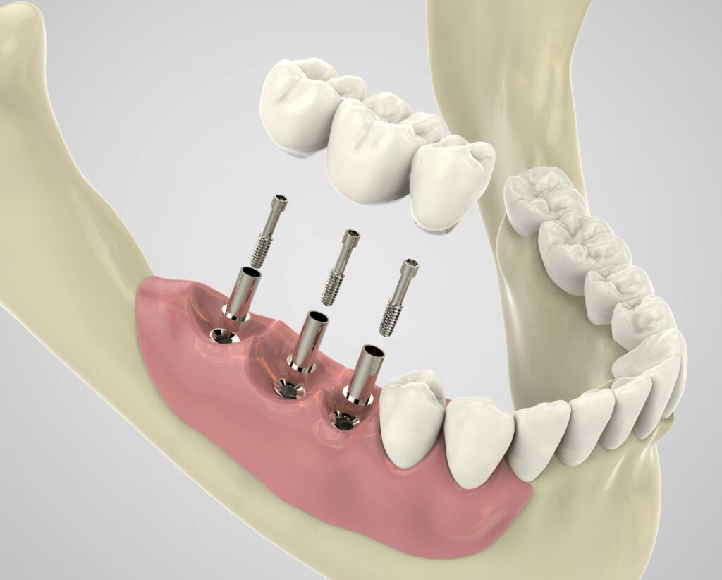 The Dental Implant Procedure
