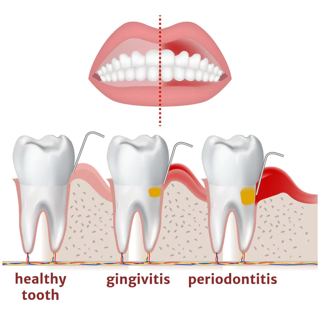 Gingivitis vs Periodontitis