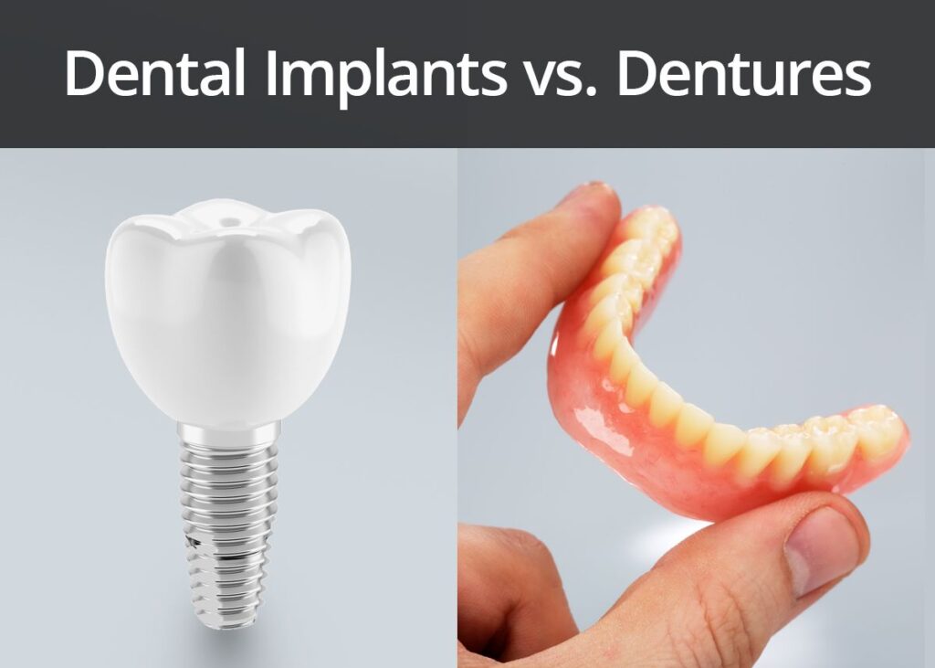 Implant-Supported vs Traditional Dentures: Full Comparison