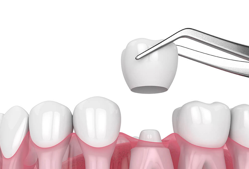 Same-Day Crowns: How CEREC Technology Works | Toronto Dentist
